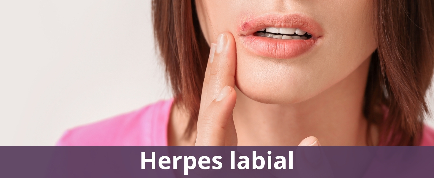 Herpes labial