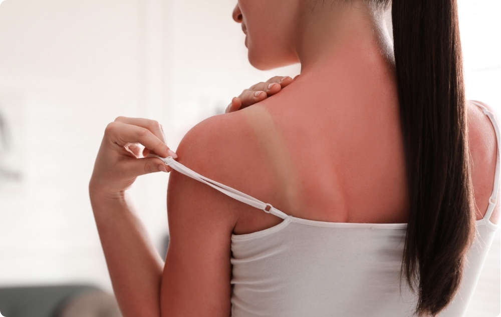 Ca ulei după arsuri solare